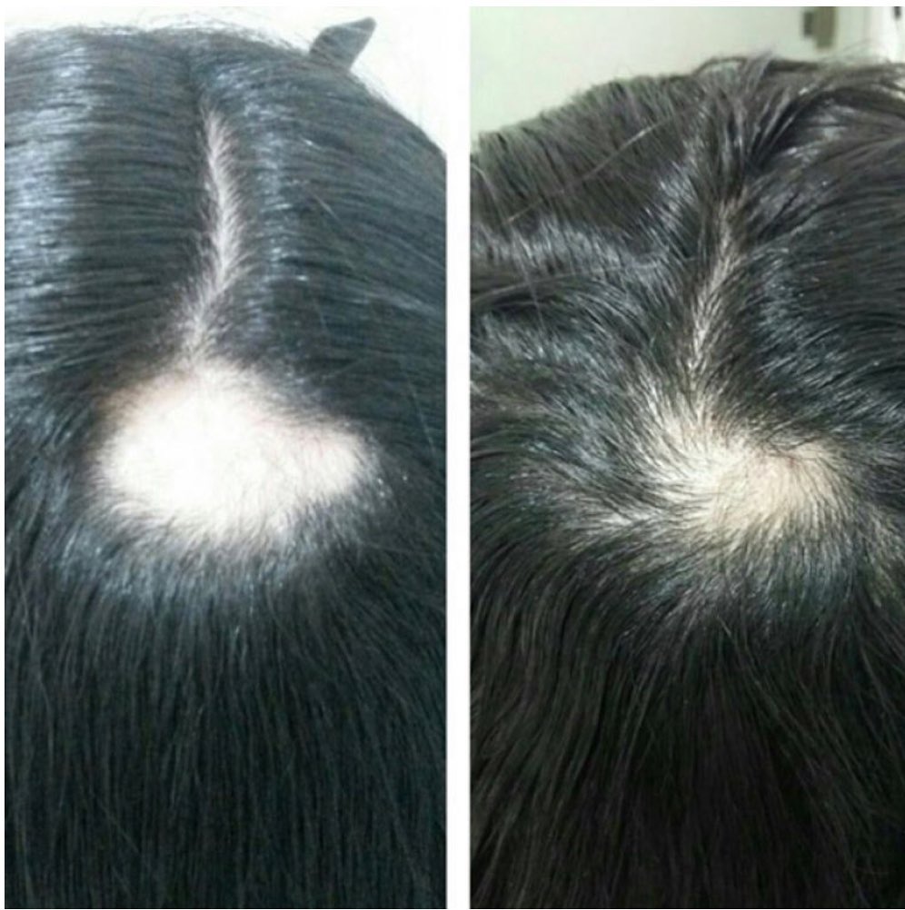 Tratamento Queda Capilar Fabiana Hair